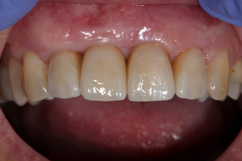 T1 T5 Couronnes dents naturelles et sur implants intra B 1