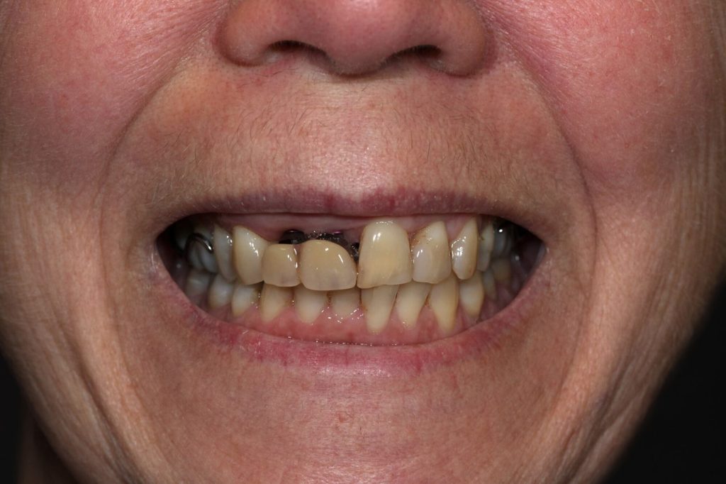 T1 T5 Couronnes dents naturelles et sur implants smile A