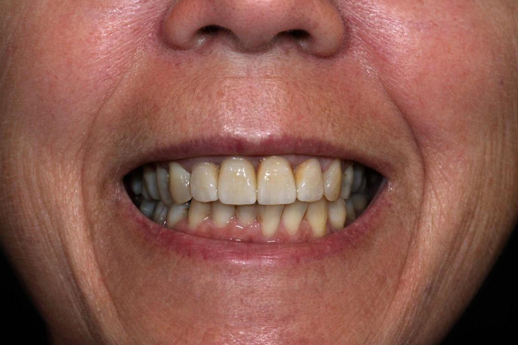 T1 T5 Couronnes dents naturelles et sur implants smile B