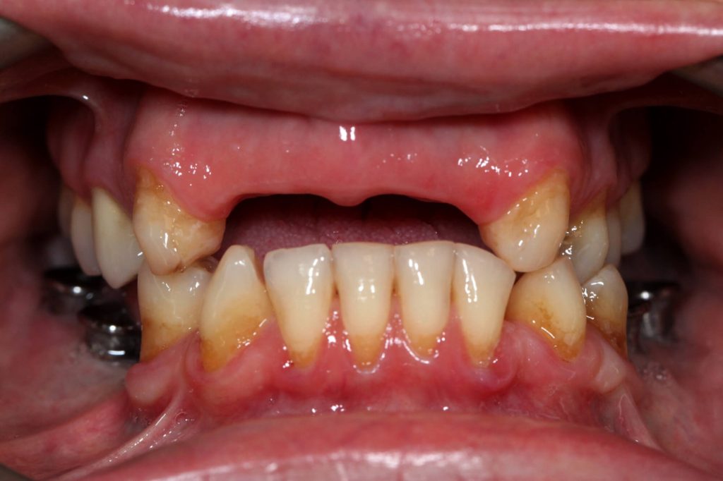 T2 T5 Pont dents naturelles et implants intra A 1