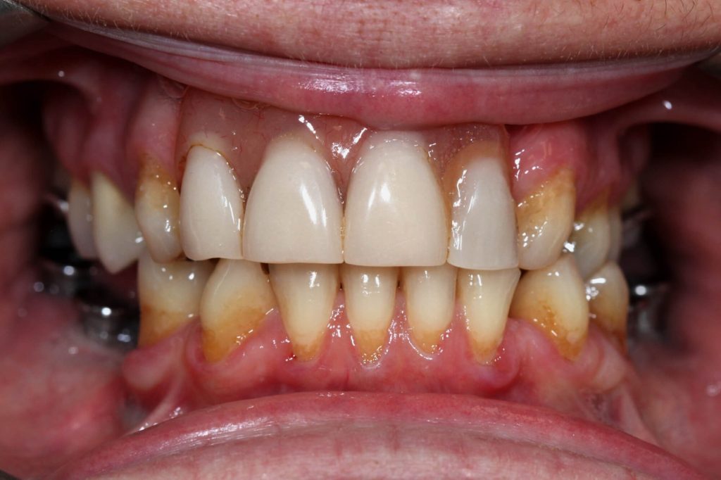 T2 T5 Pont dents naturelles et implants intra B 1