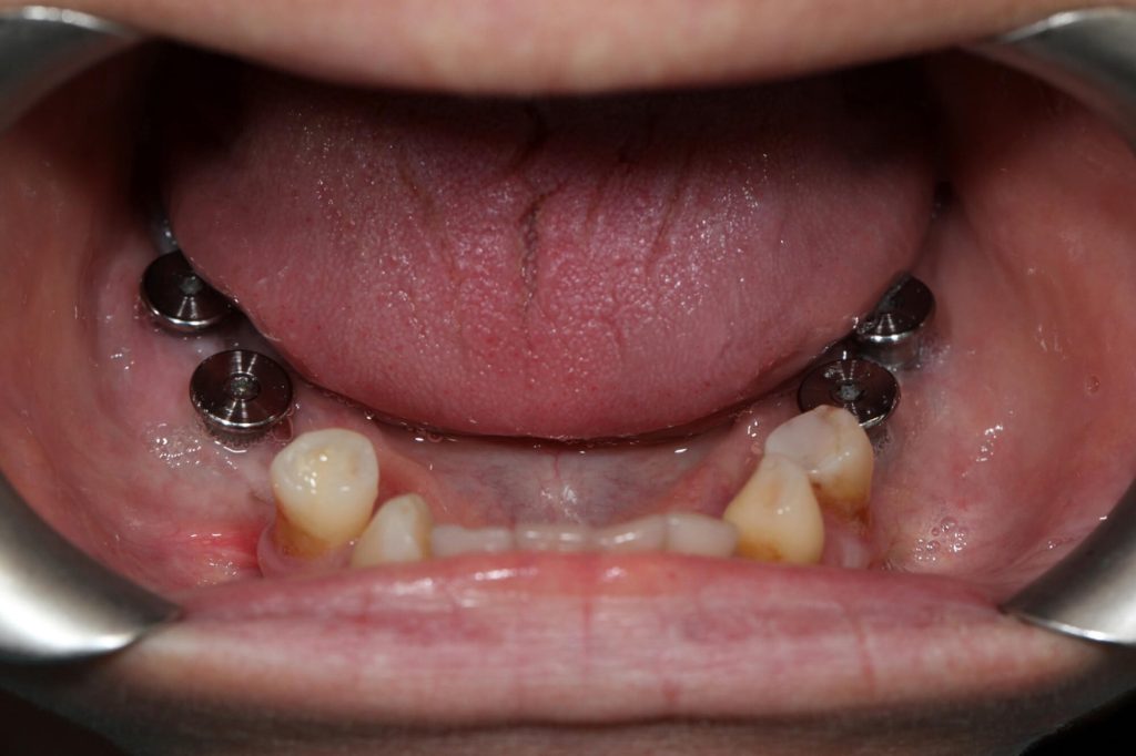 T2 T5 Pont dents naturelles et implants intra C 1