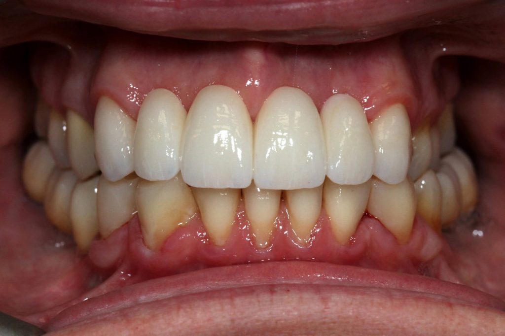 T2 T5 Pont dents naturelles et implants intra D 1