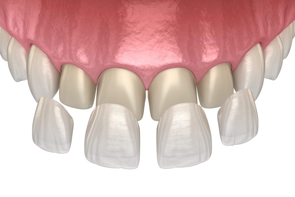 T4 Facette en porcelaine et composite A