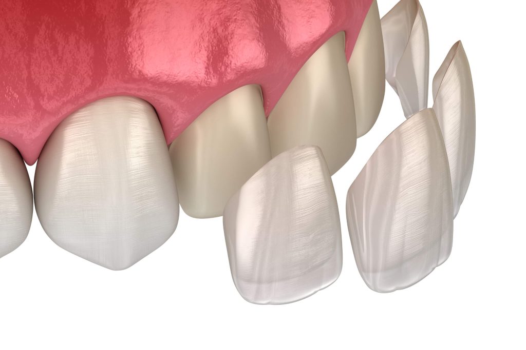 T4 Facette en porcelaine et composite B