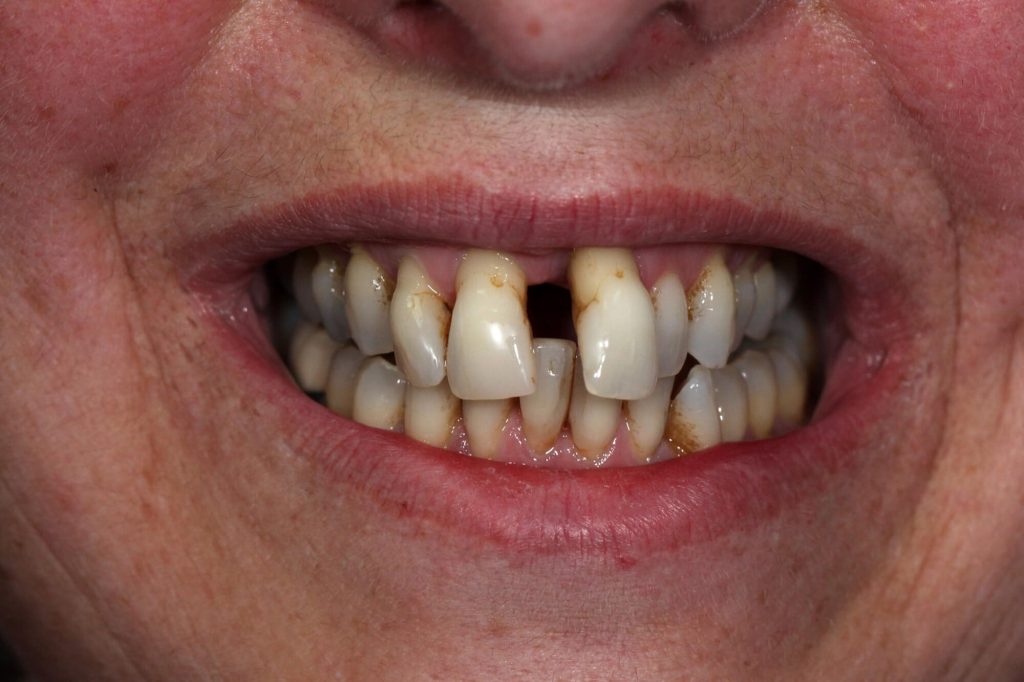 T5 Pont 2 implants anterieurs smile A 1