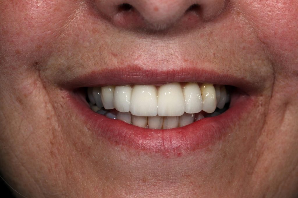 T5 Pont 2 implants anterieurs smile B 1