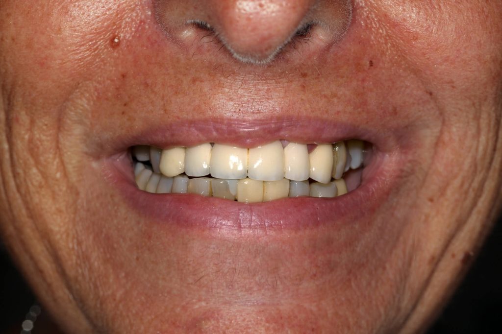 T5 Pont implant anterieur smile A 1