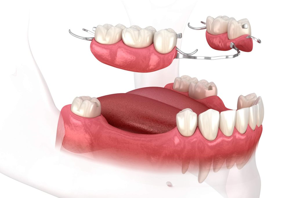 T6 Prothese partielle amovible A