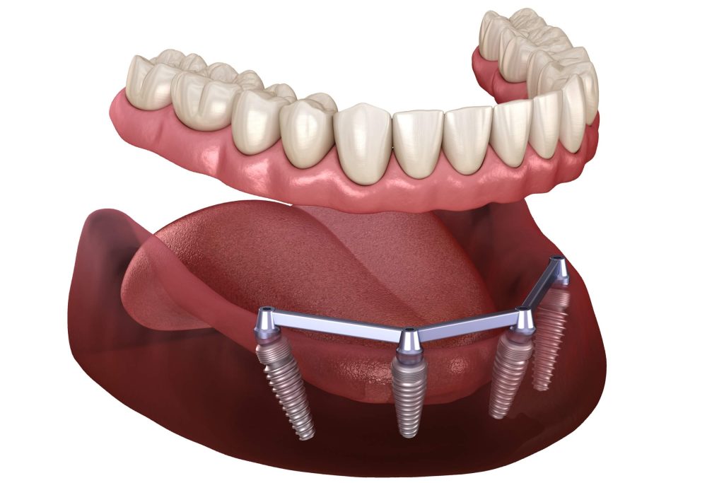 T8 Prothese complete amovible sur implants A