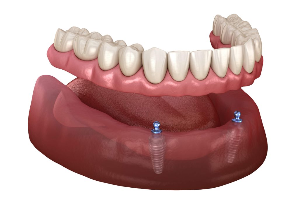 T8 Prothese complete amovible sur implants B