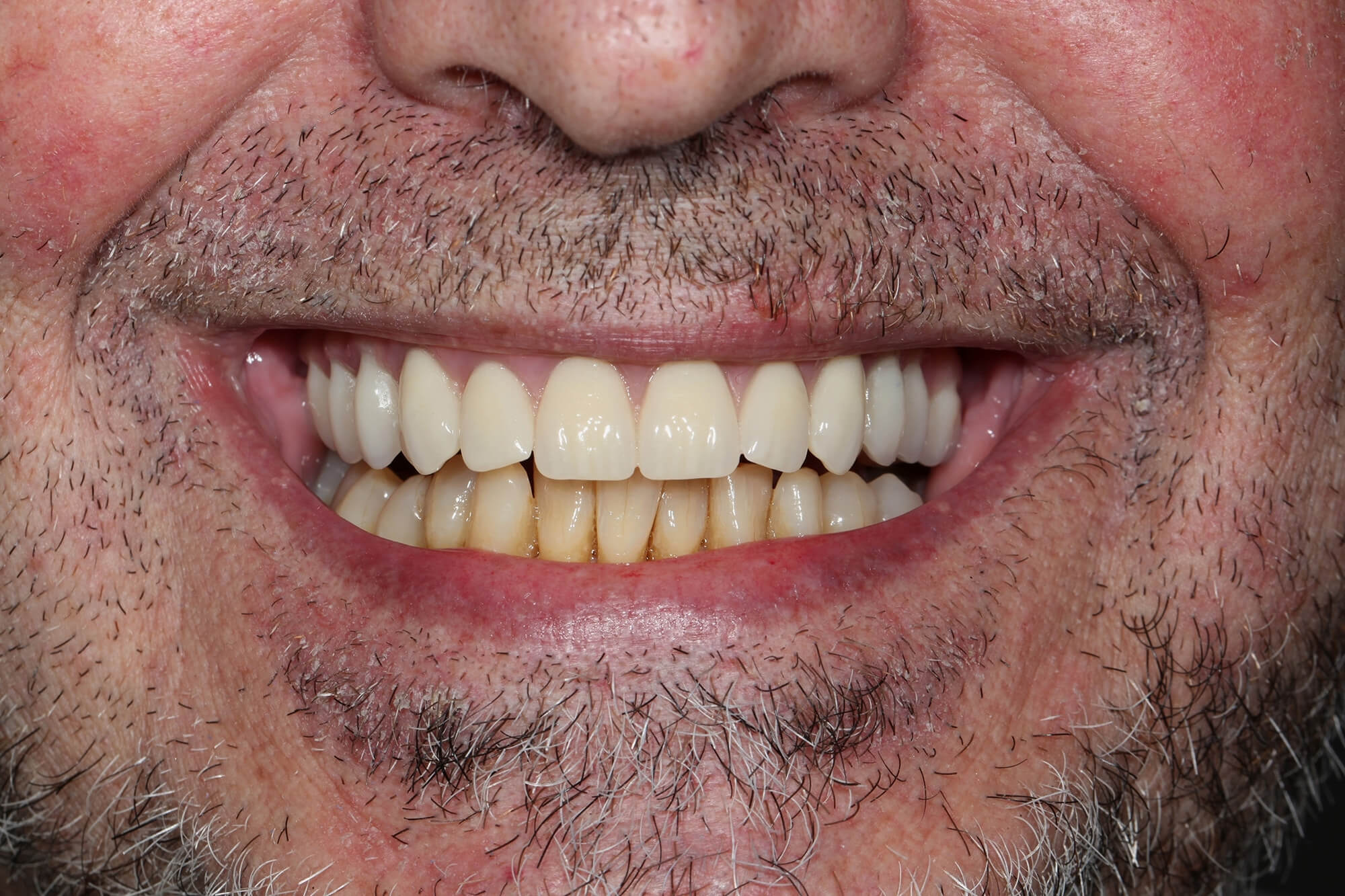 T9 C fixe implants smile B 1