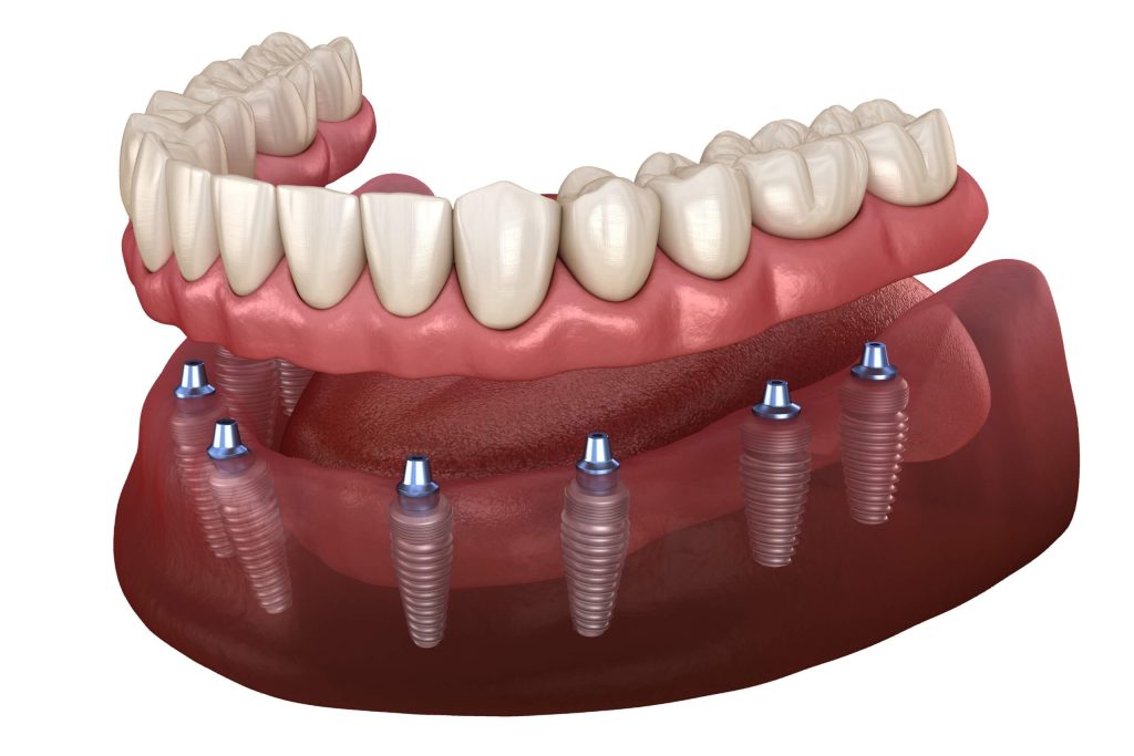 T9 Prothese complete fixe sur implants A