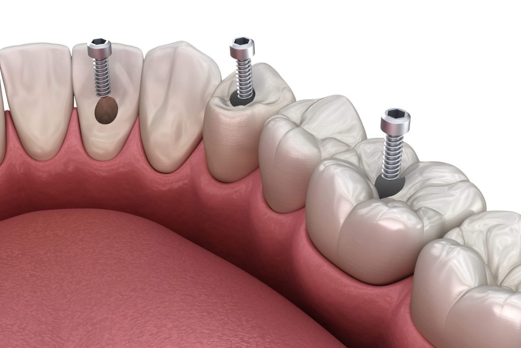 T9 Prothese complete fixe sur implants B