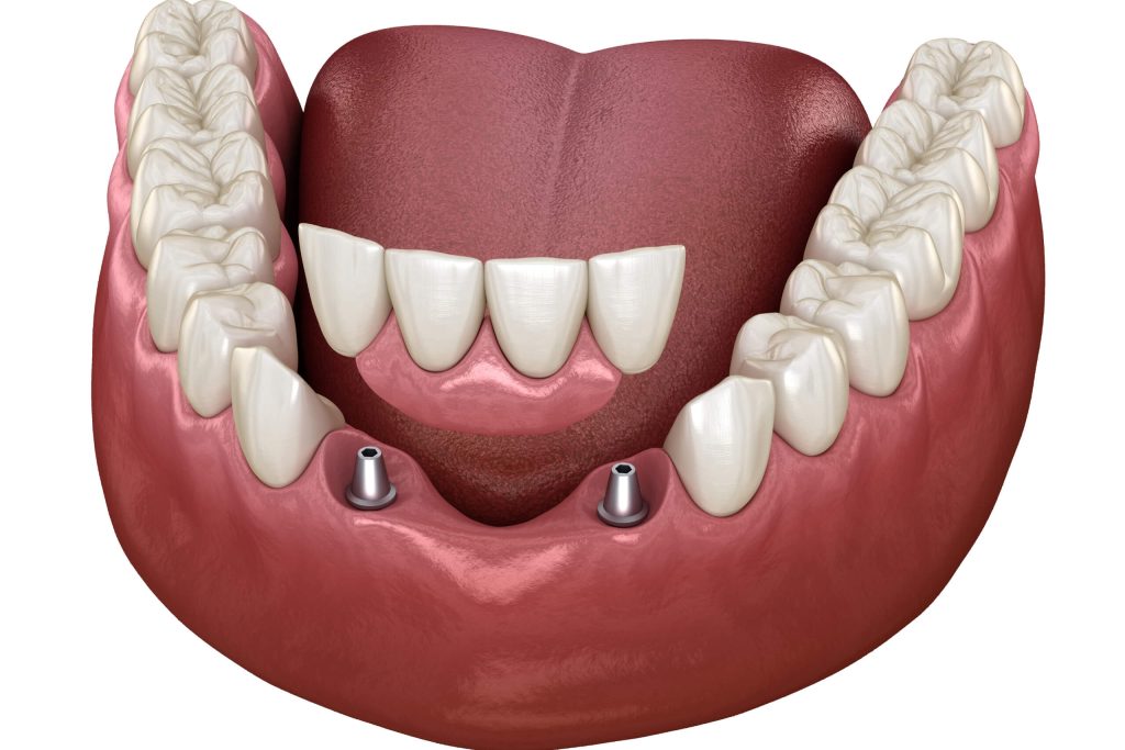 T5 Couronne ou Pont sur implant B